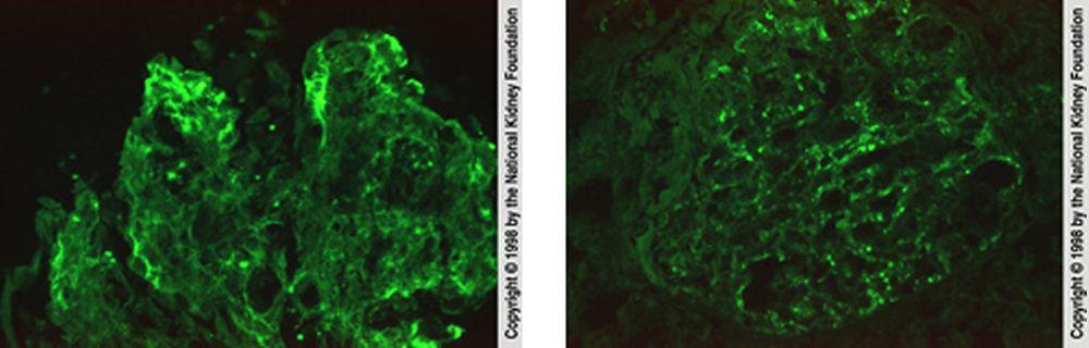 Glomérulonéphrite post-infectieuse (coloration par immunofluorescence)