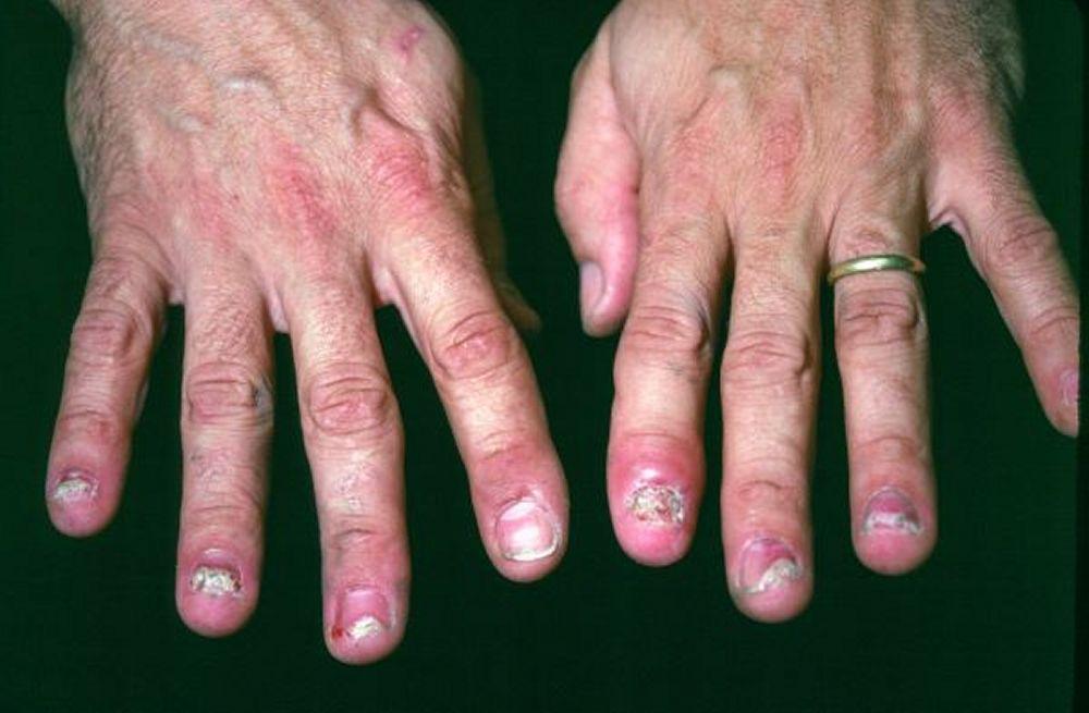Arthrites réactionnelles (ongles)