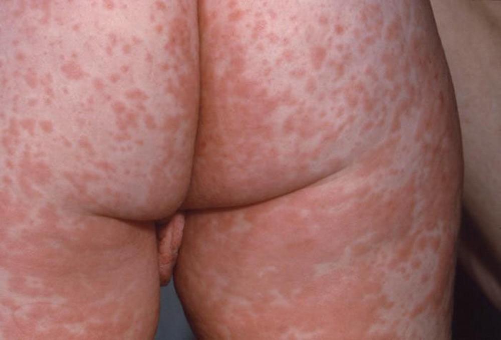 Measles (Macular Rash)
