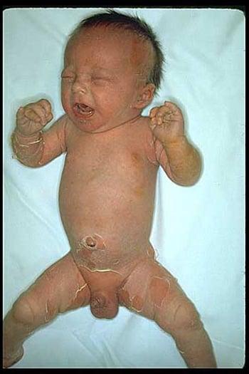 Síndrome estafilocócico de la piel escaldada (infante)