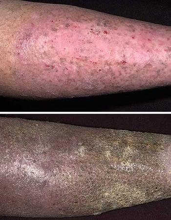 Dermatite de stase (modifications chroniques)
