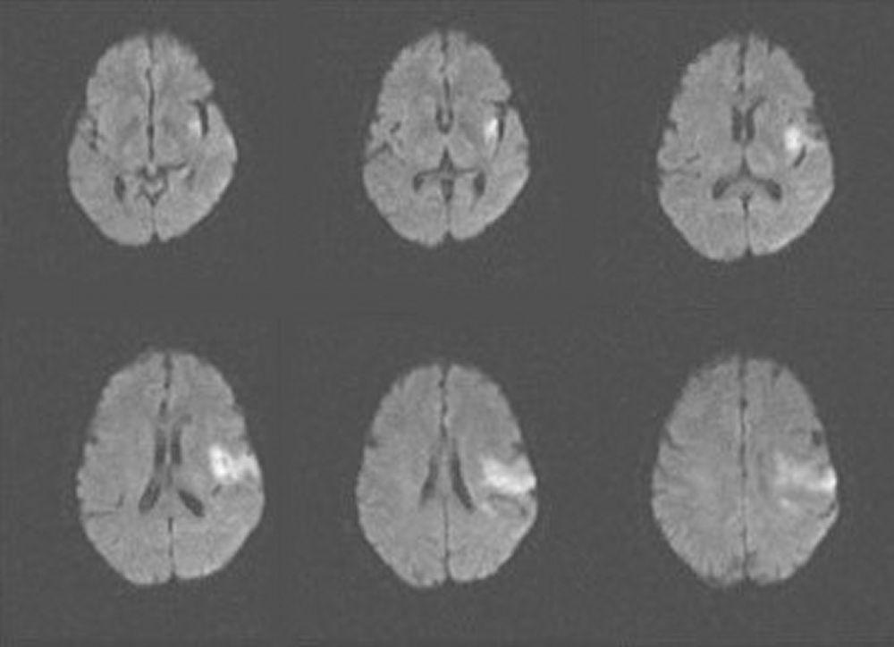 Accident vasculaire cérébral ischémique aigu dans les lobes insulaires et frontaux gauches (IRM)