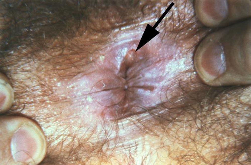 Sífilis primaria (chancro anal)