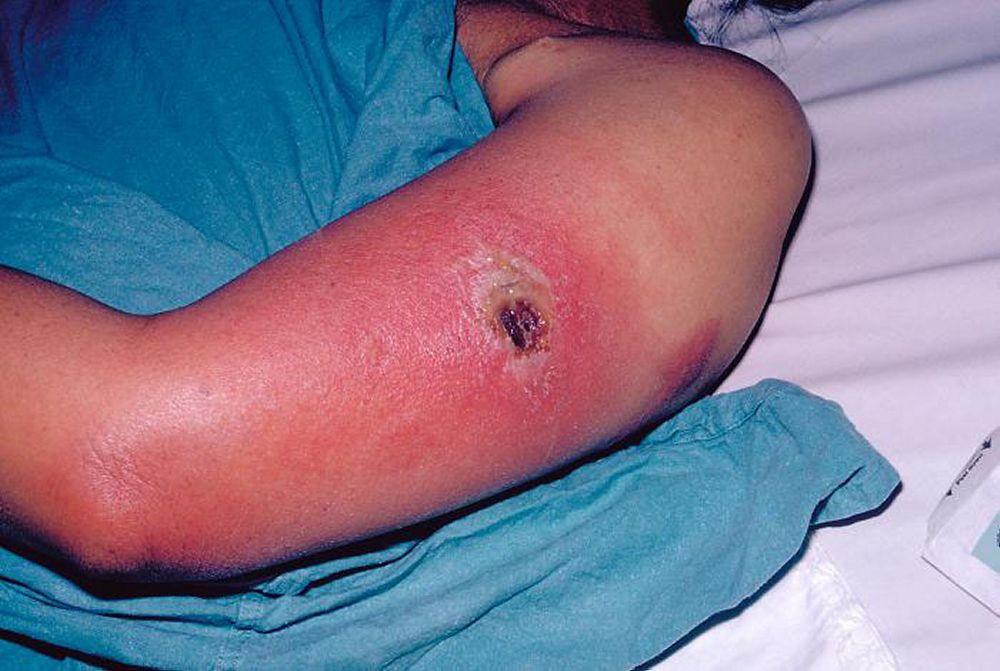 Enfermedad por el virus vaccinia: progresiva (compromiso de la piel descrito como enfermedad necrosante por el virus vaccinia)